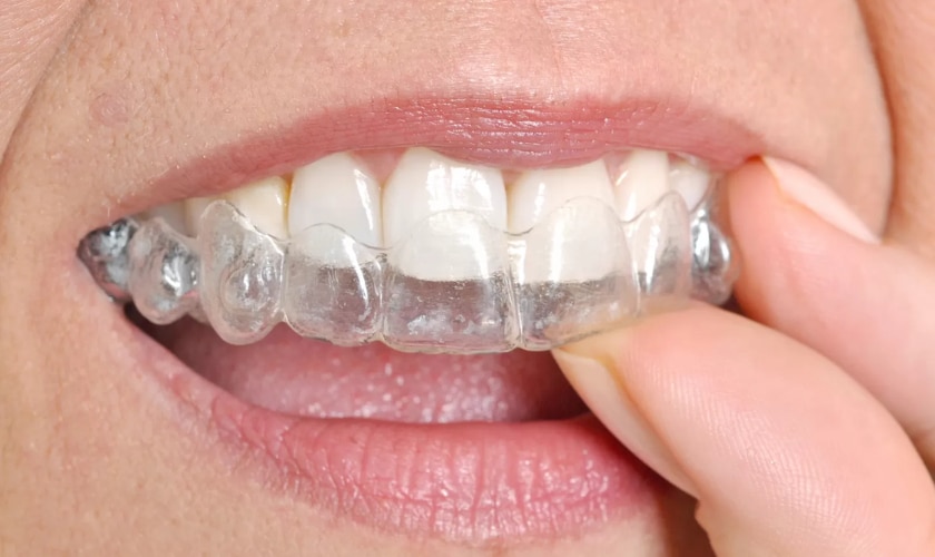 Invisalign® - Smile Studio Dental – Dentist Denver