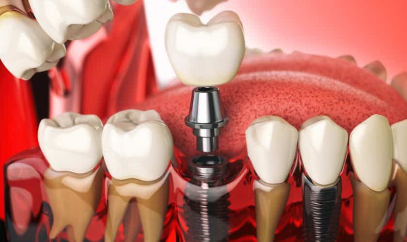 Dental Implant Denver - Smile Studio Dental Denver